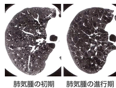 肺気腫の初期と進行期の図